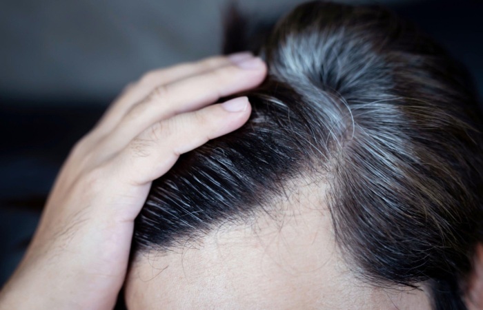 What Are The Causes Of White Hair?